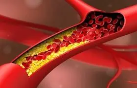 ۴ نوشیدنی پیشگیری کننده از گرفتگی عروق